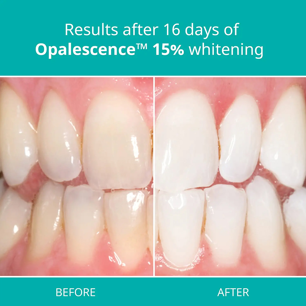 Teeth Whitening Gel Home Kit D - Teeth Whitening Gel Opalescence avaliação e preço