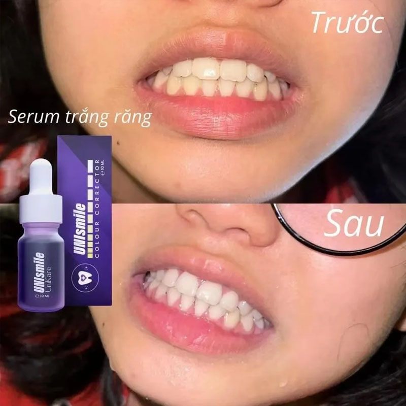 Unismile Teeth Whitening Essen - Teeth Whitening Effective avaliação e preço