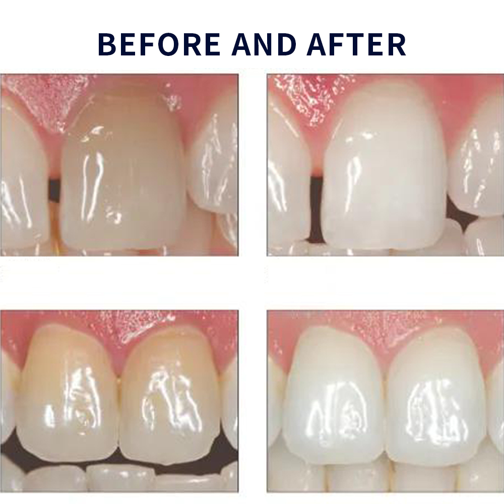 Opalescence Whitening 20% PF 2 - Teeth Whitening Flash avaliação e preço