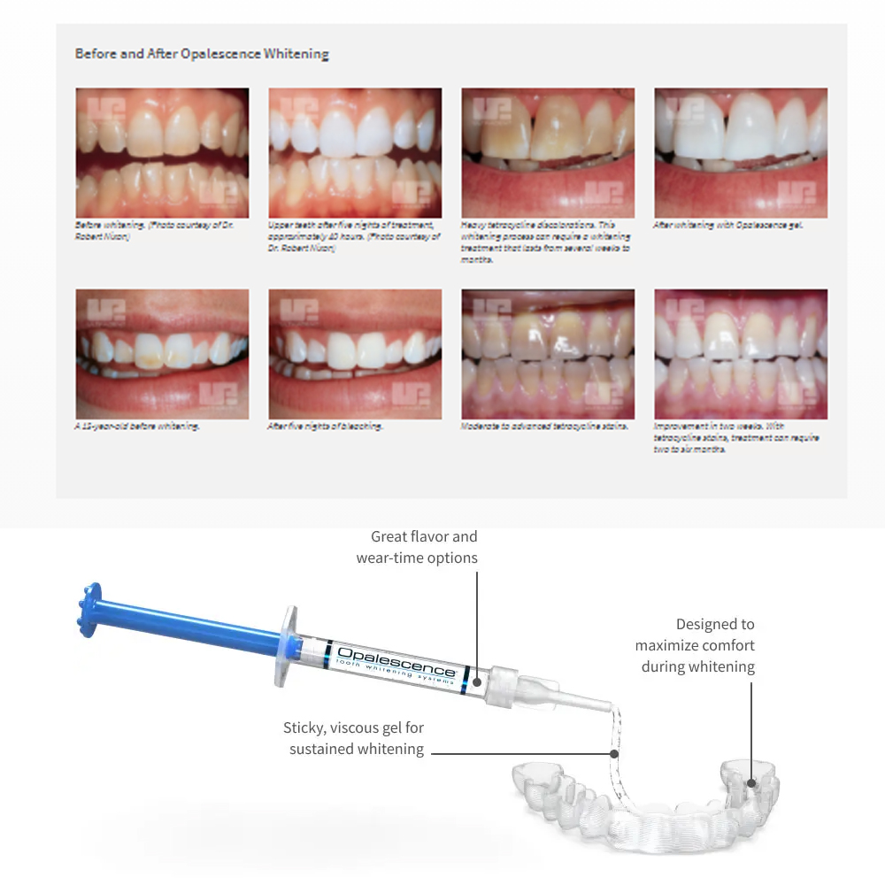 Opalescence Whitening 20% PF 2 - Teeth Whitening Flash avaliação e preço