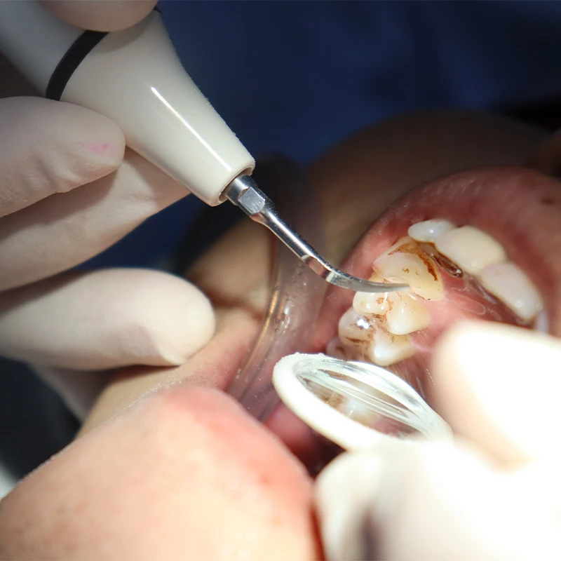 Scaler Handpiece Tube Cable fo - Teeth Whitening Youtube avaliação e preço