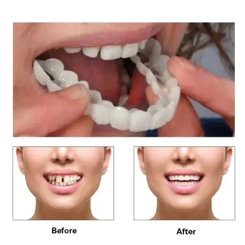 Whitening Teeth Veneers Dentur - Teeth Whitening Effective avaliação e preço