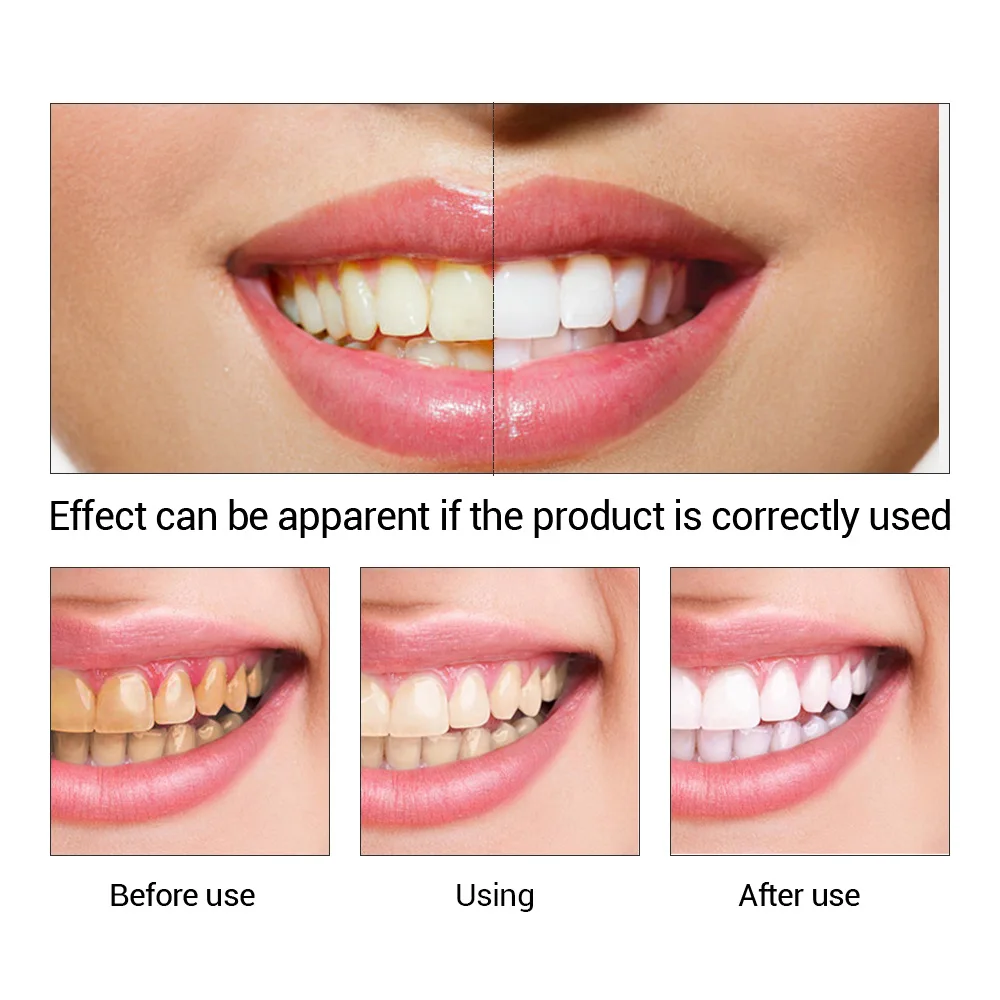 FTEENPLY Teeth Whitening Essen - Teeth Whitening Effective avaliação e preço