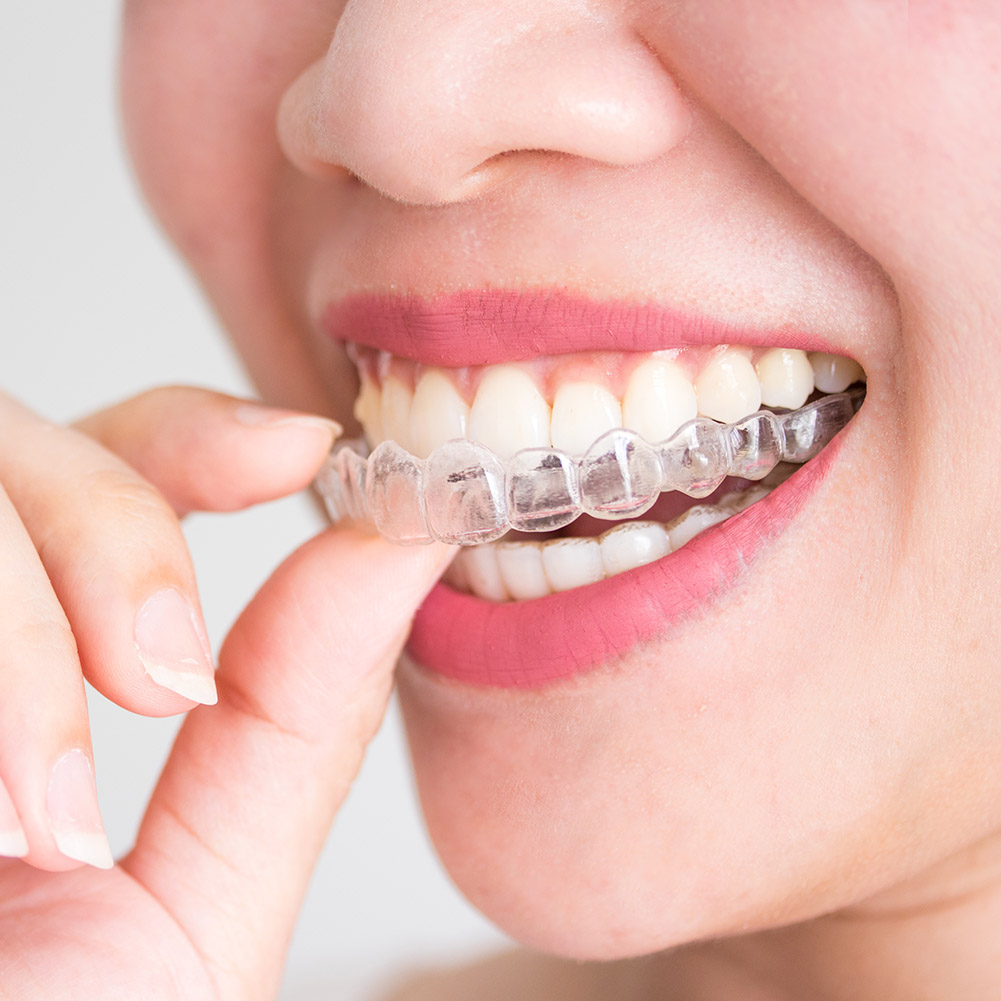2/4pcs Professional Tooth Orth - Teeth Whitening With Trays avaliação e preço