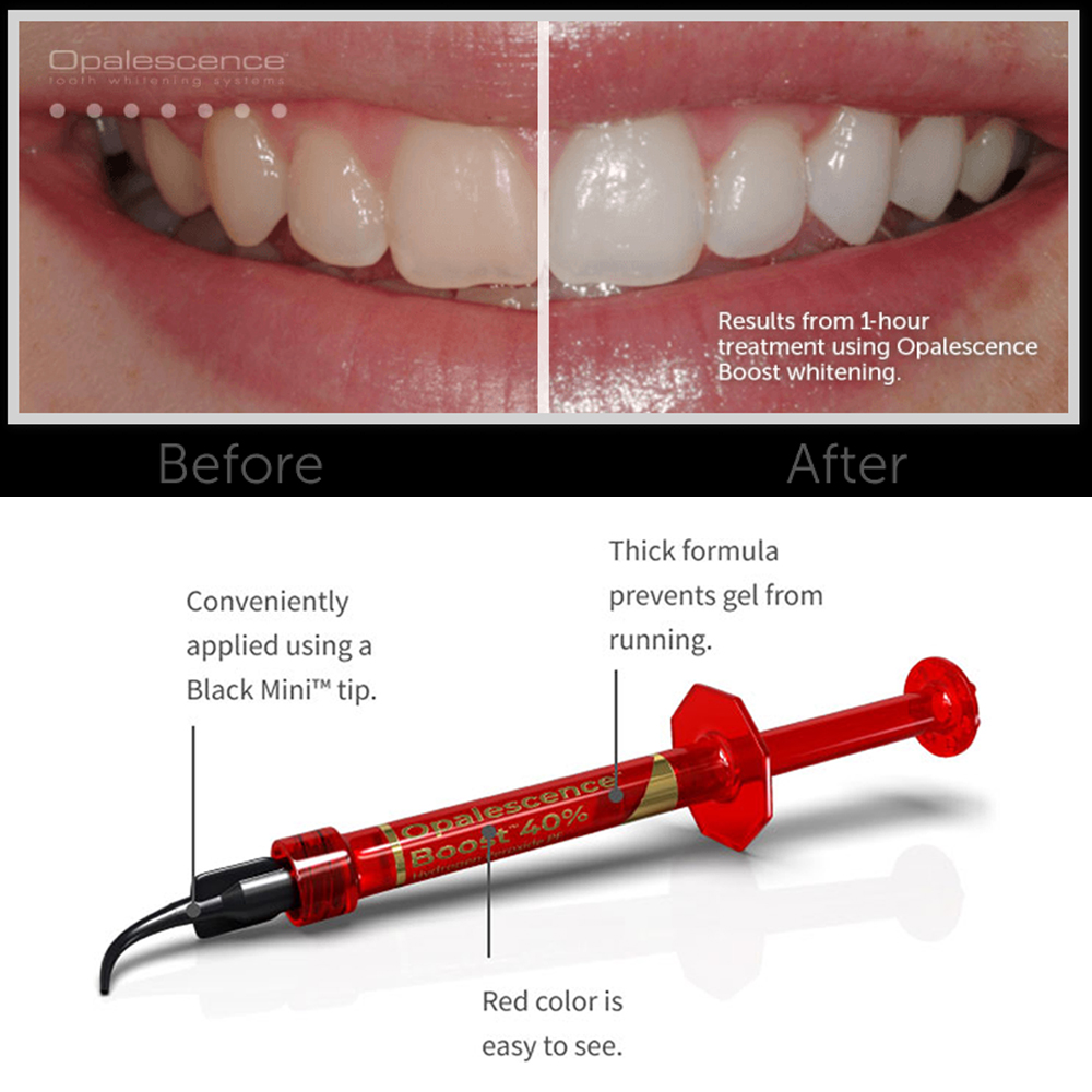 Ultradent Opalescence Boost PF - Teeth Whitening Gel Opalescence avaliação e preço