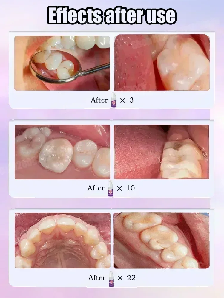 Teeth Cleaning Toothpaste Remo - Teeth Whitening Effective avaliação e preço